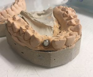 культя зуба 22 восстановлена ЛКШВ 2