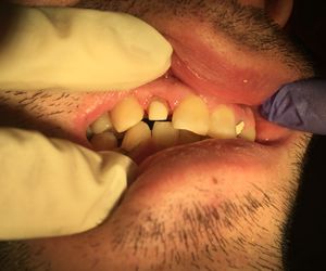 Культя зуба 12 восстановлем пломбировочным материалом на СВШ