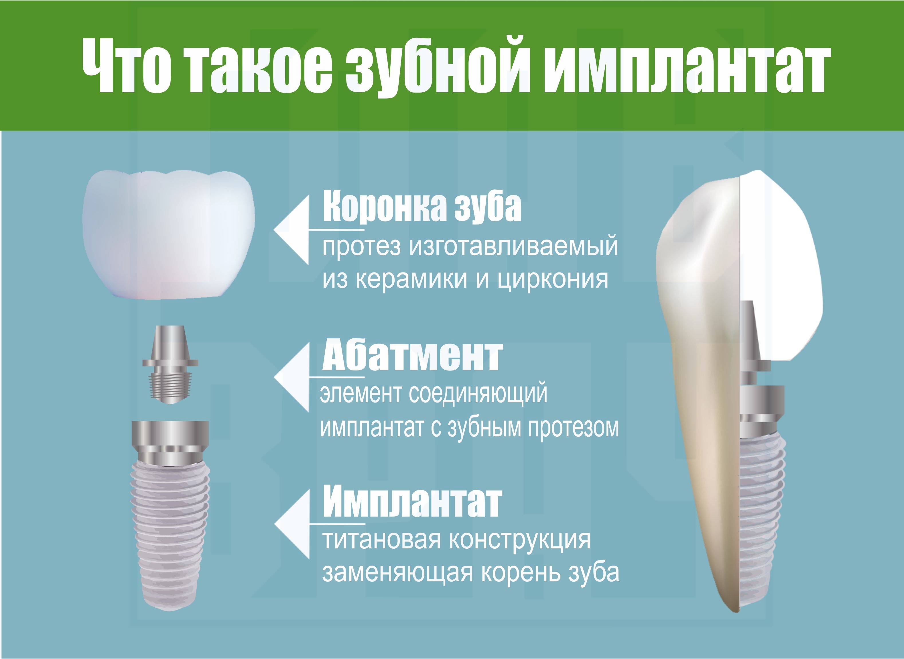 Инфографика_что_такое_зубной_имплантат